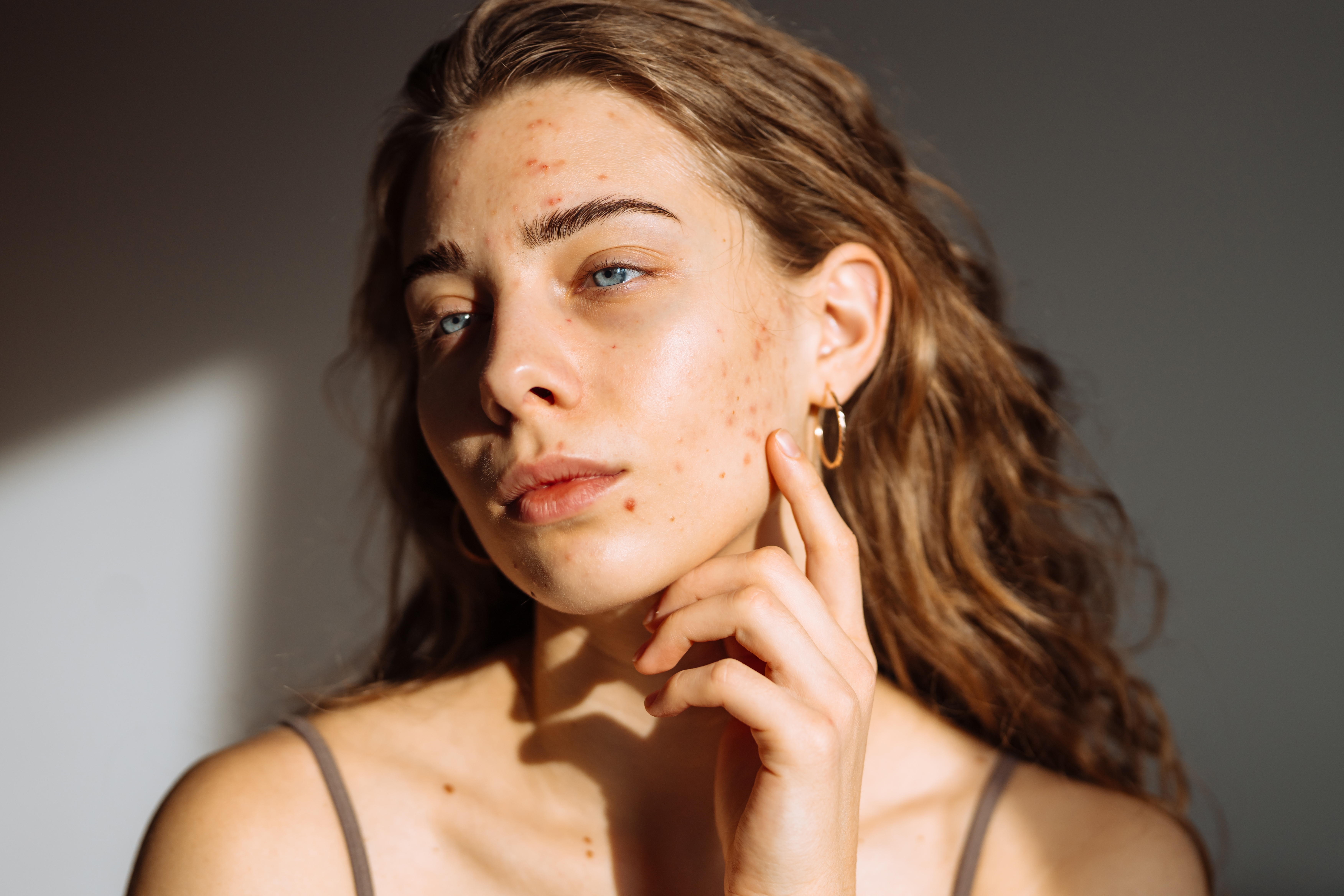 Unreine Haut & Akne – Ursachen, Pflege und ganzheitliche Lösungen