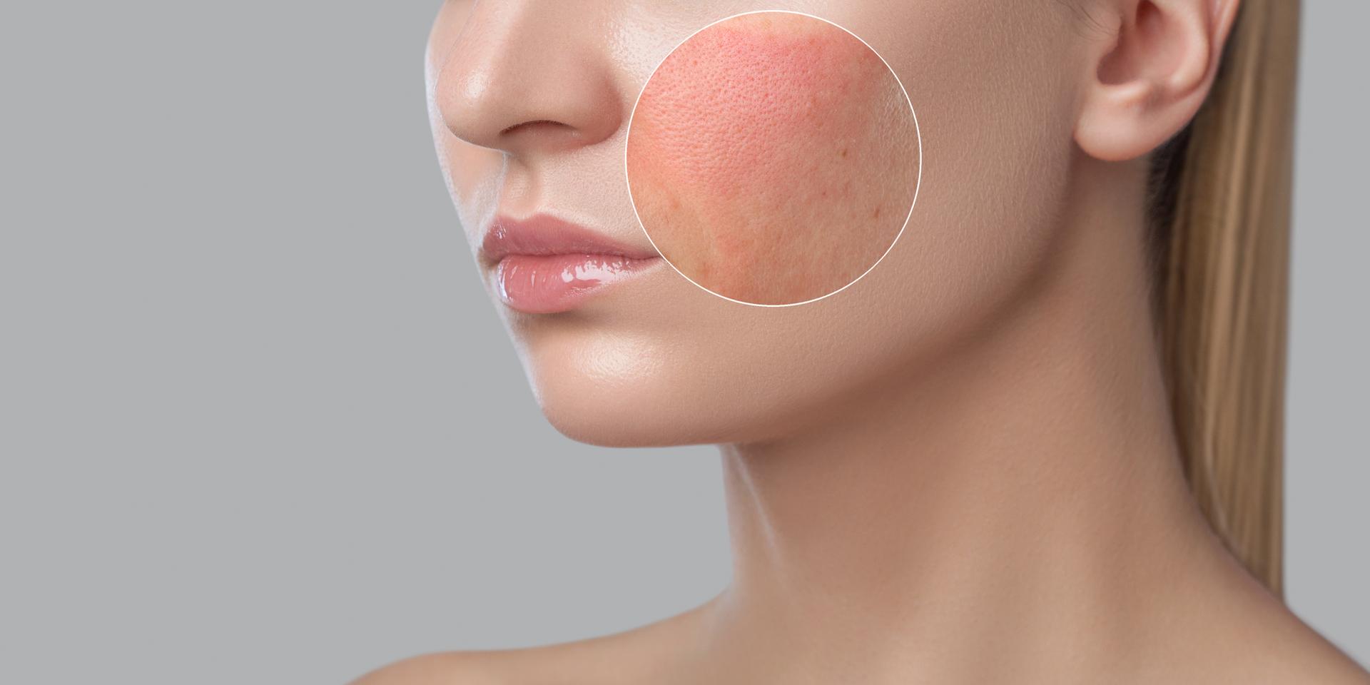 Vergrößerte Ansicht geröteter Haut bei Rosacea